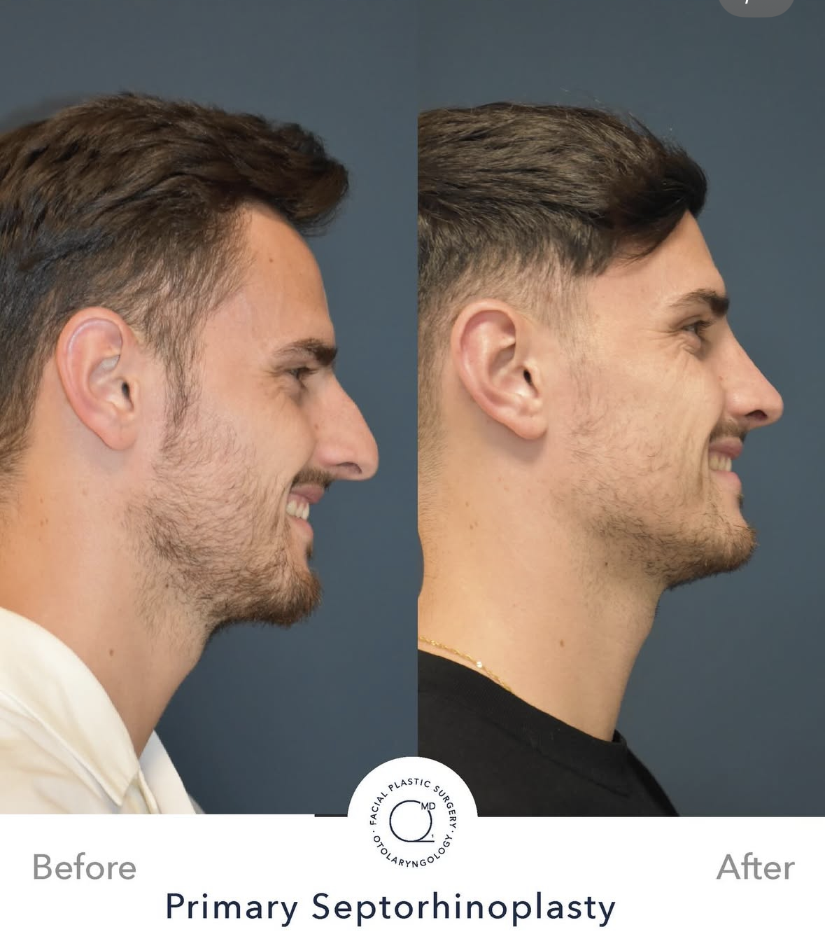 Rinoplastia masculina antes y después — fotografía 5