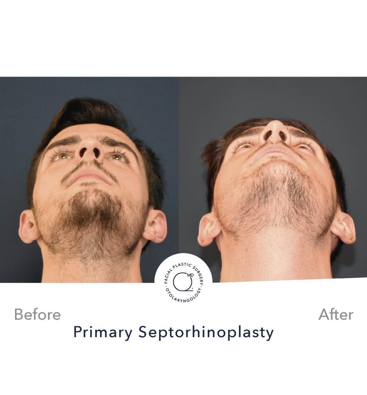 Rinoplastia masculina antes y después — fotografía 6