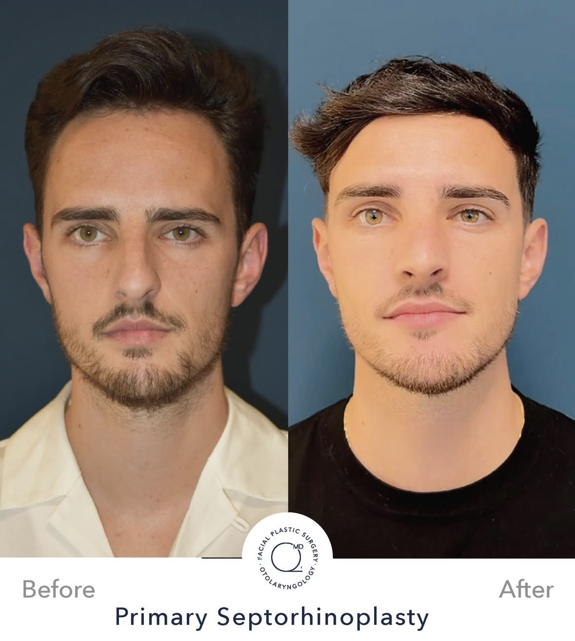 Rinoplastia masculina antes y después — fotografía 7