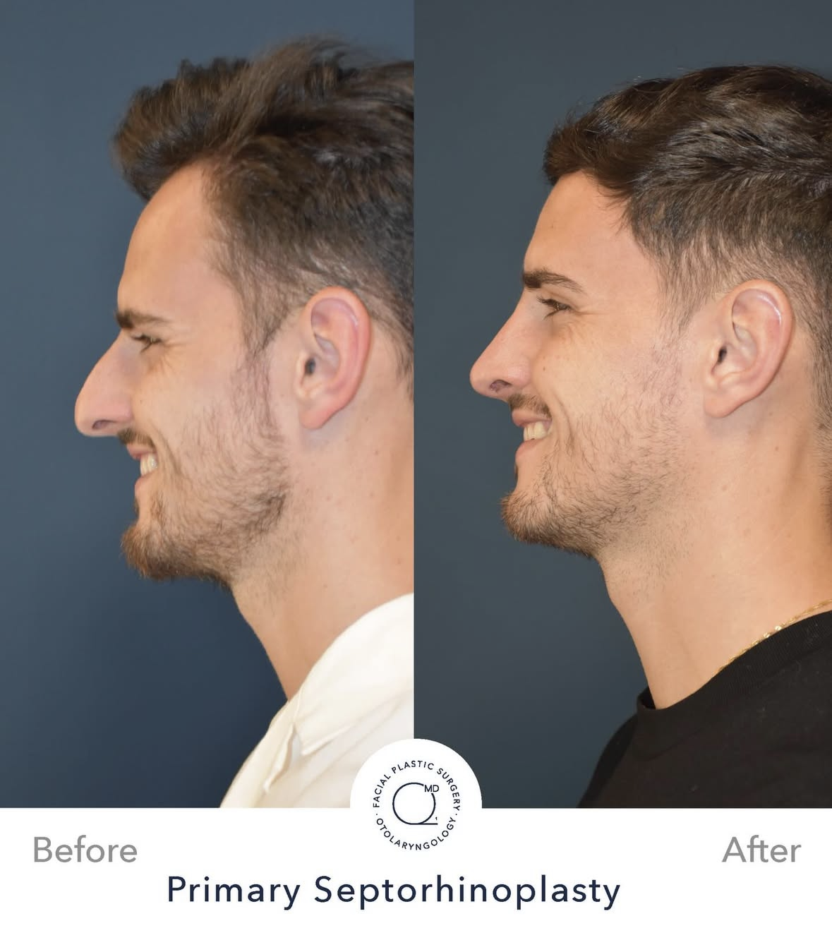 Rinoplastia masculina antes y después — fotografía 8