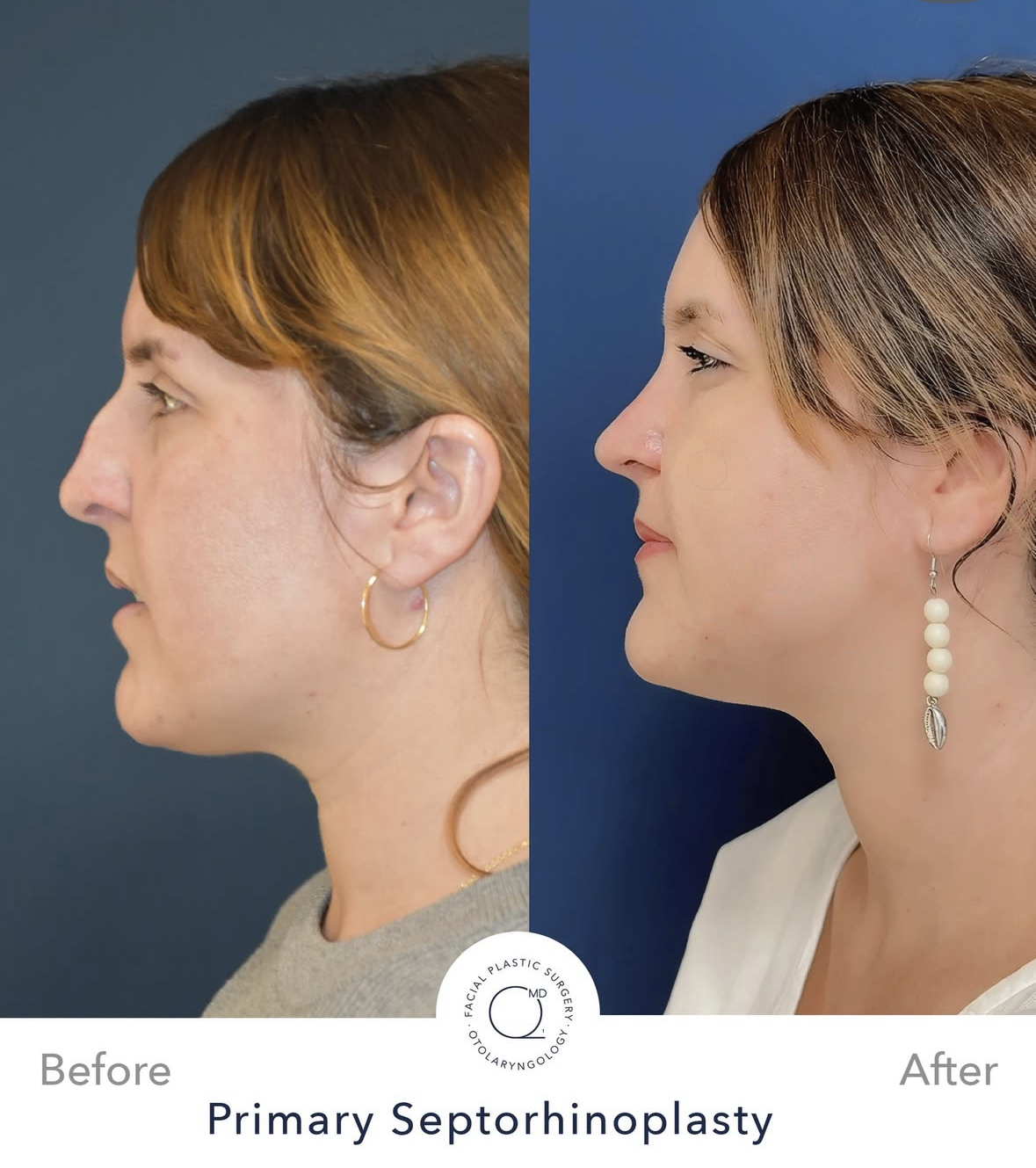 Rinoplastia femenina antes y después — fotografía 1