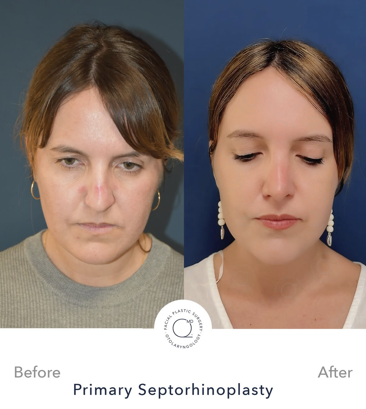 Rinoplastia femenina antes y después — fotografía 2