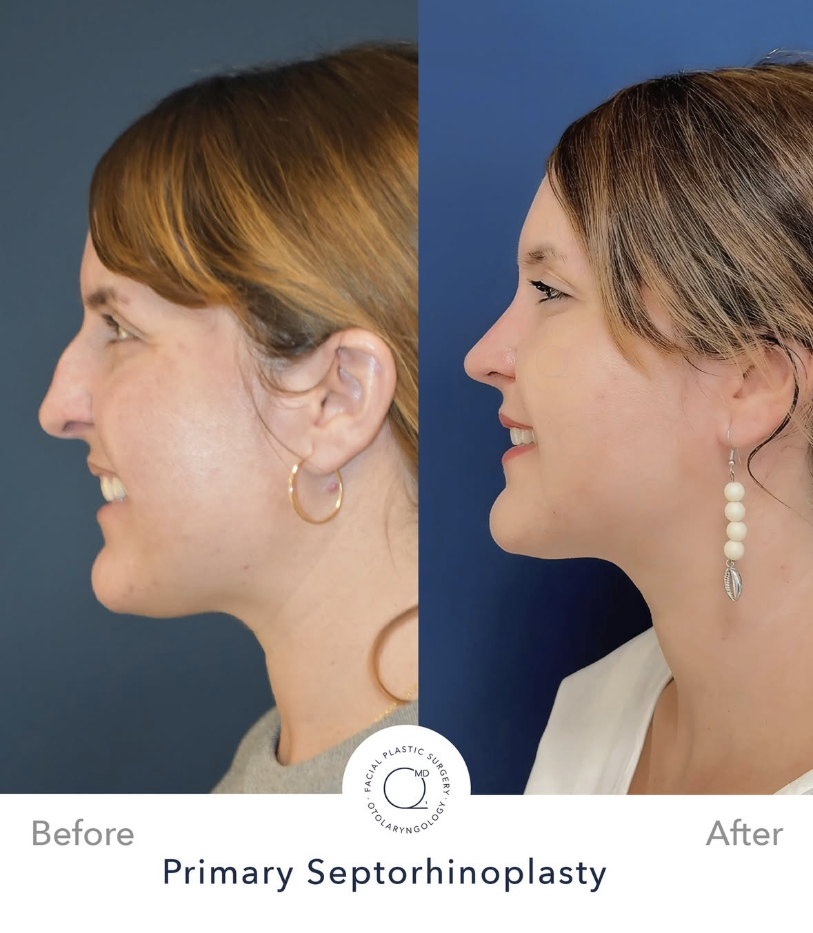 Rinoplastia femenina antes y después — fotografía 3