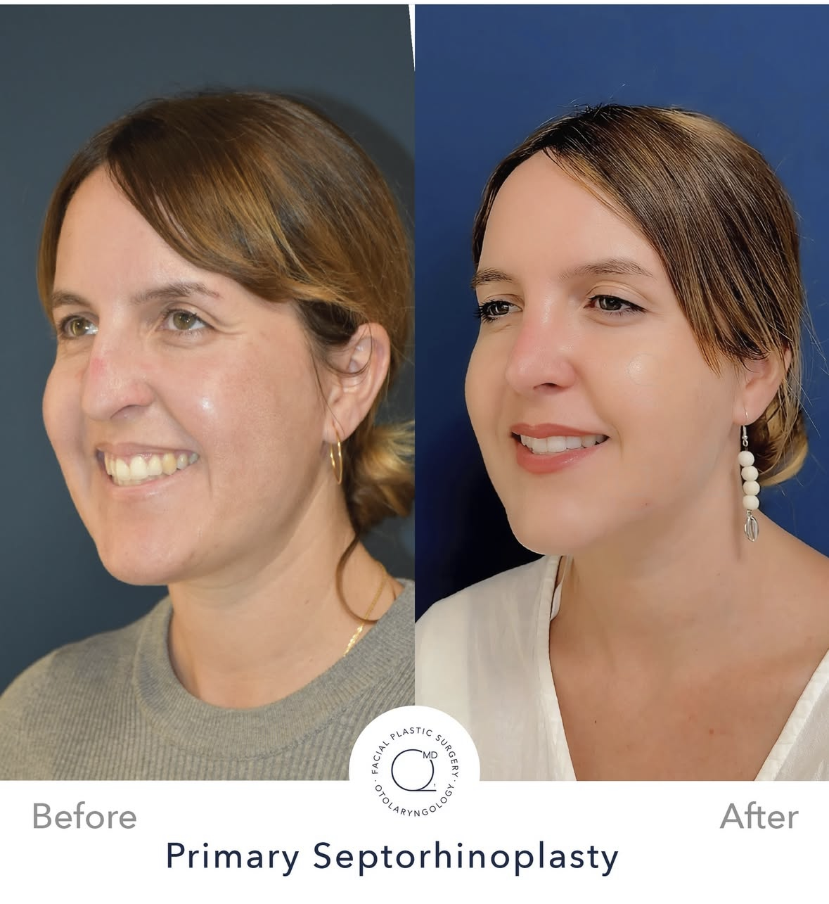 Rinoplastia femenina antes y después — fotografía 4