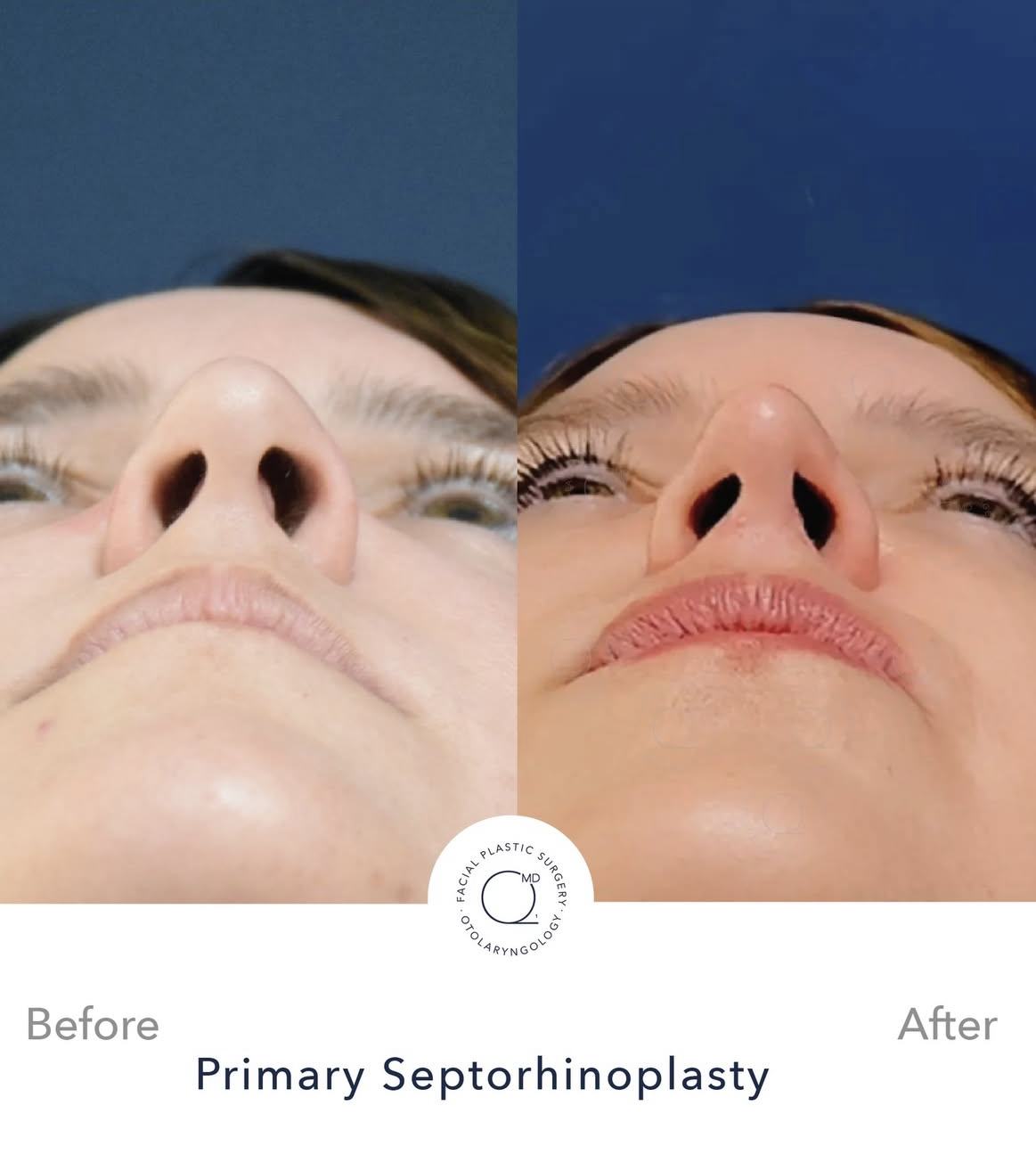 Rinoplastia femenina antes y después — fotografía 5