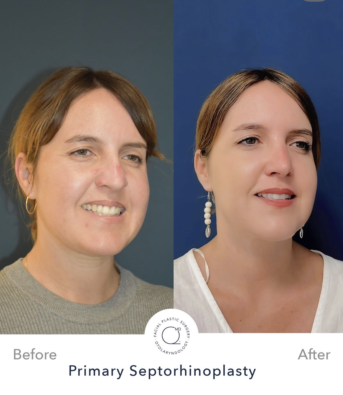 Rinoplastia femenina antes y después — fotografía 6