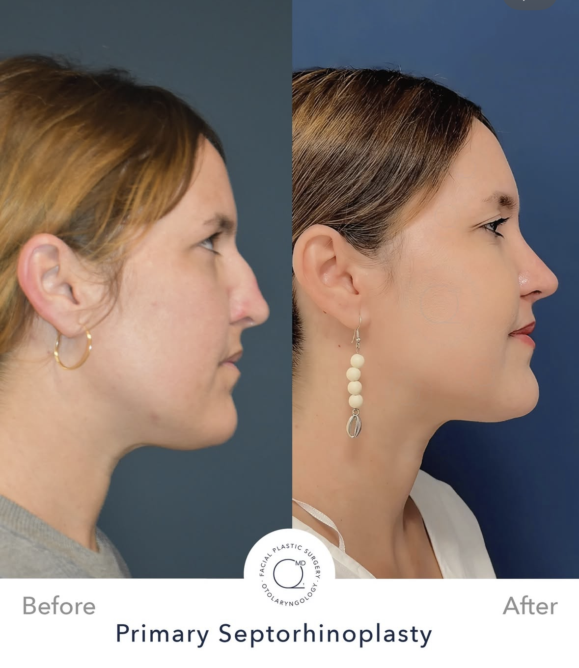 Rinoplastia femenina antes y después — fotografía 7