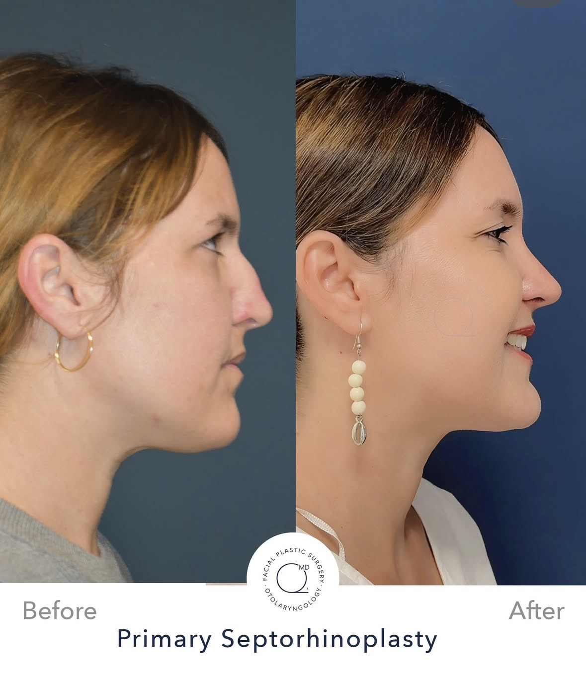 Rinoplastia femenina antes y después — fotografía 8