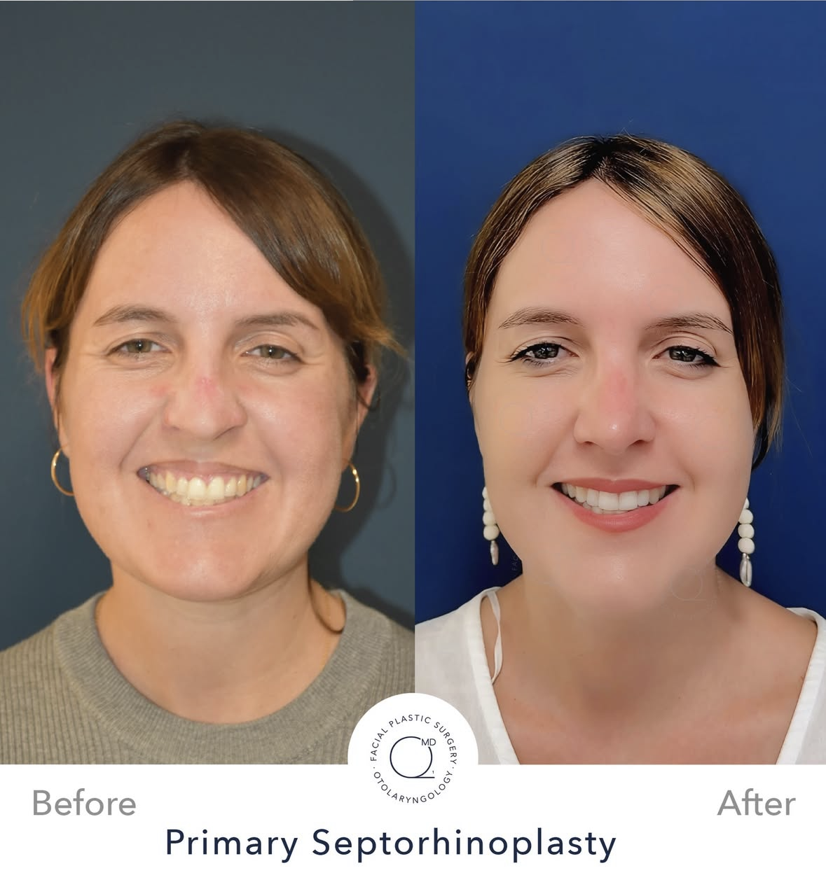 Rinoplastia femenina antes y después — fotografía 9