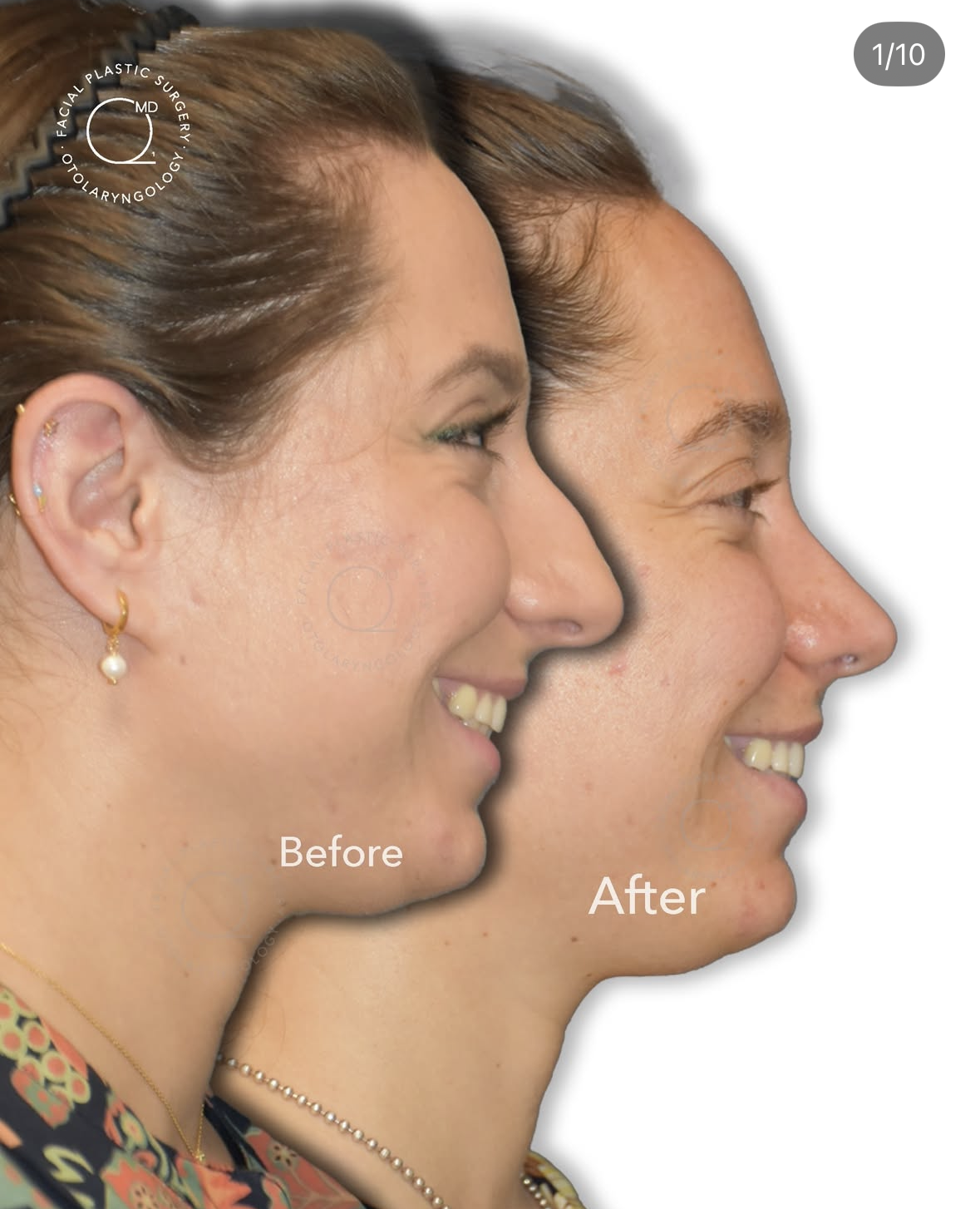 Rinoplastia femenina antes y después