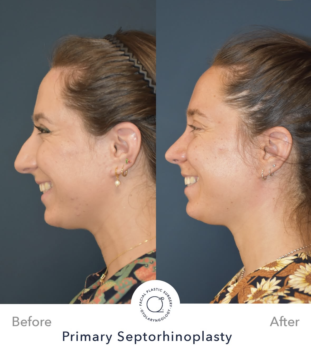 Rinoplastia femenina antes y después — fotografía 1