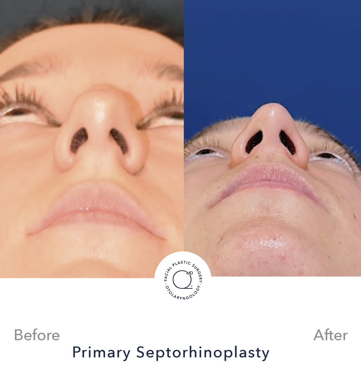 Rinoplastia femenina antes y después — fotografía 2