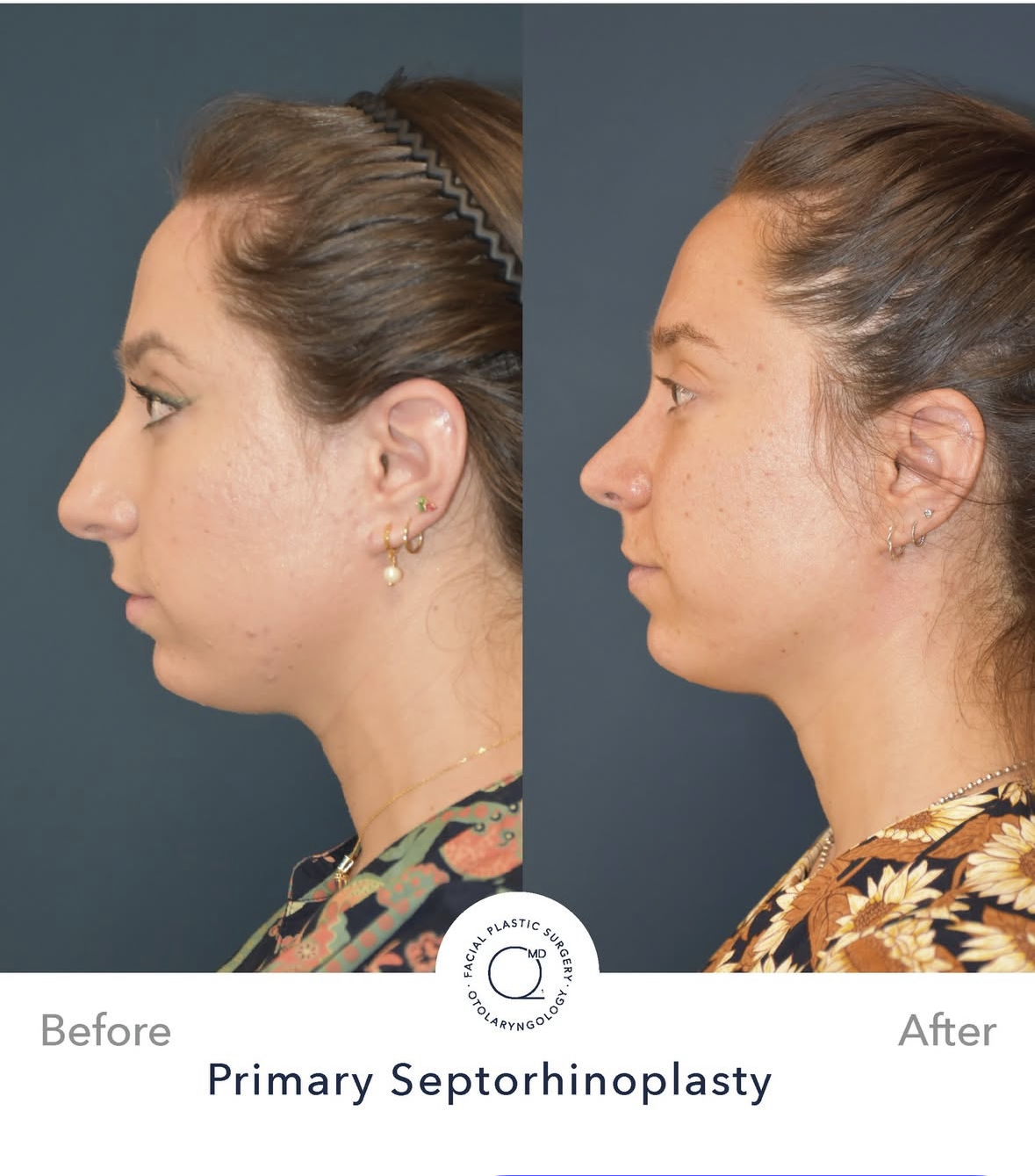 Rinoplastia femenina antes y después — fotografía 3