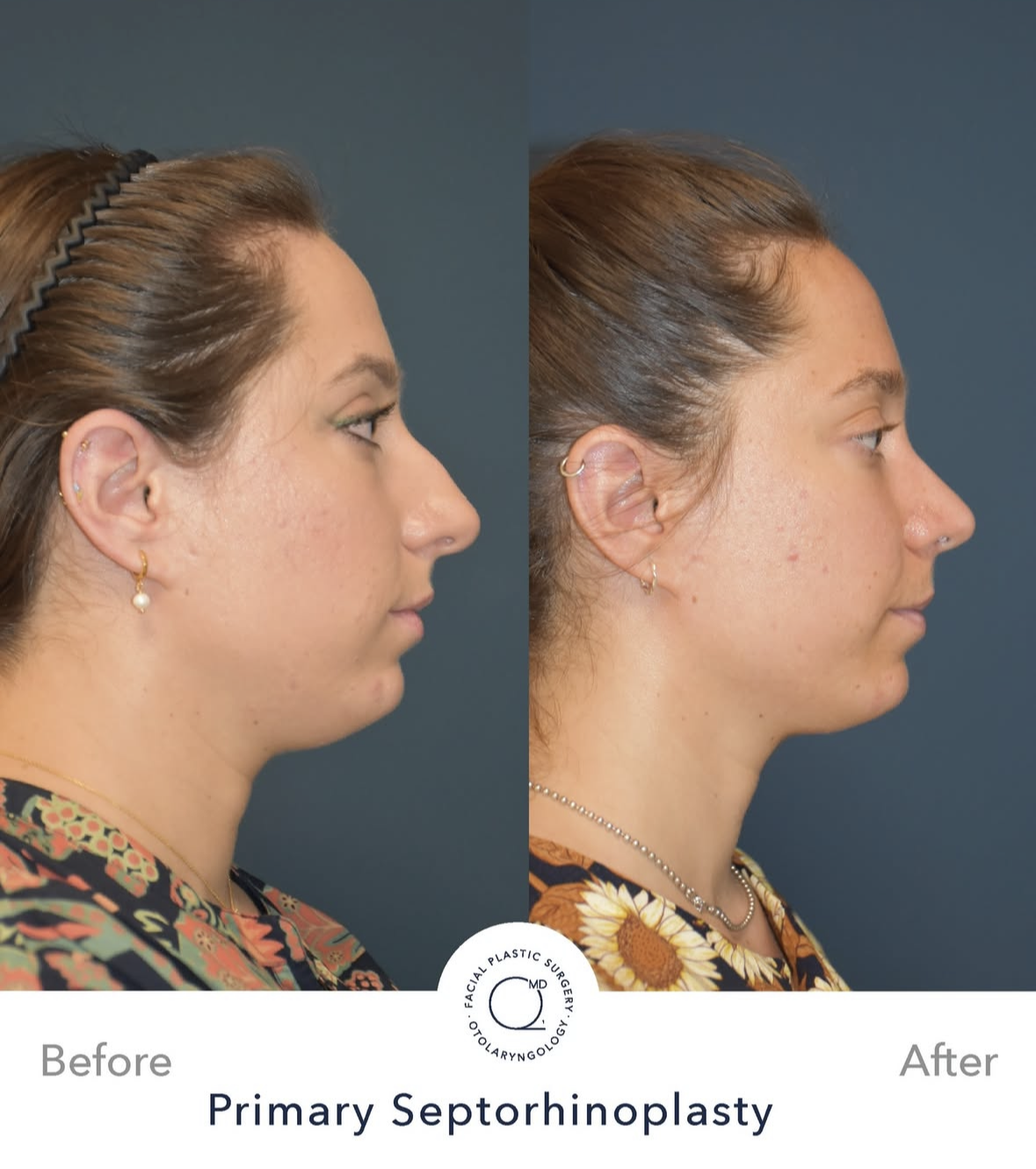 Rinoplastia femenina antes y después — fotografía 4
