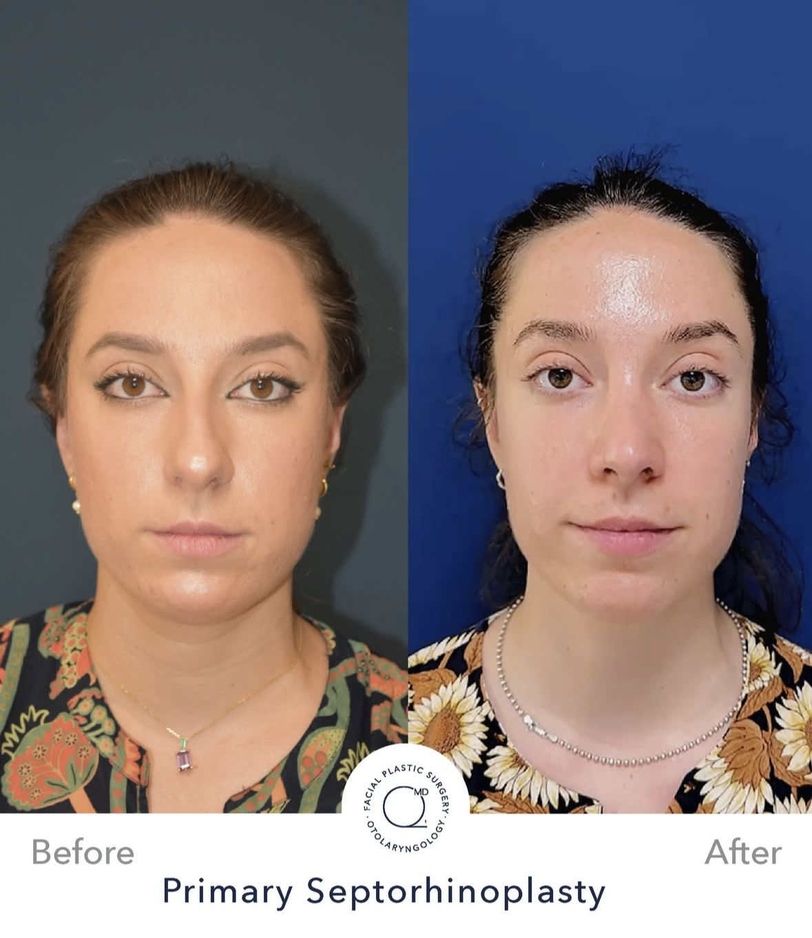 Rinoplastia femenina antes y después — fotografía 5