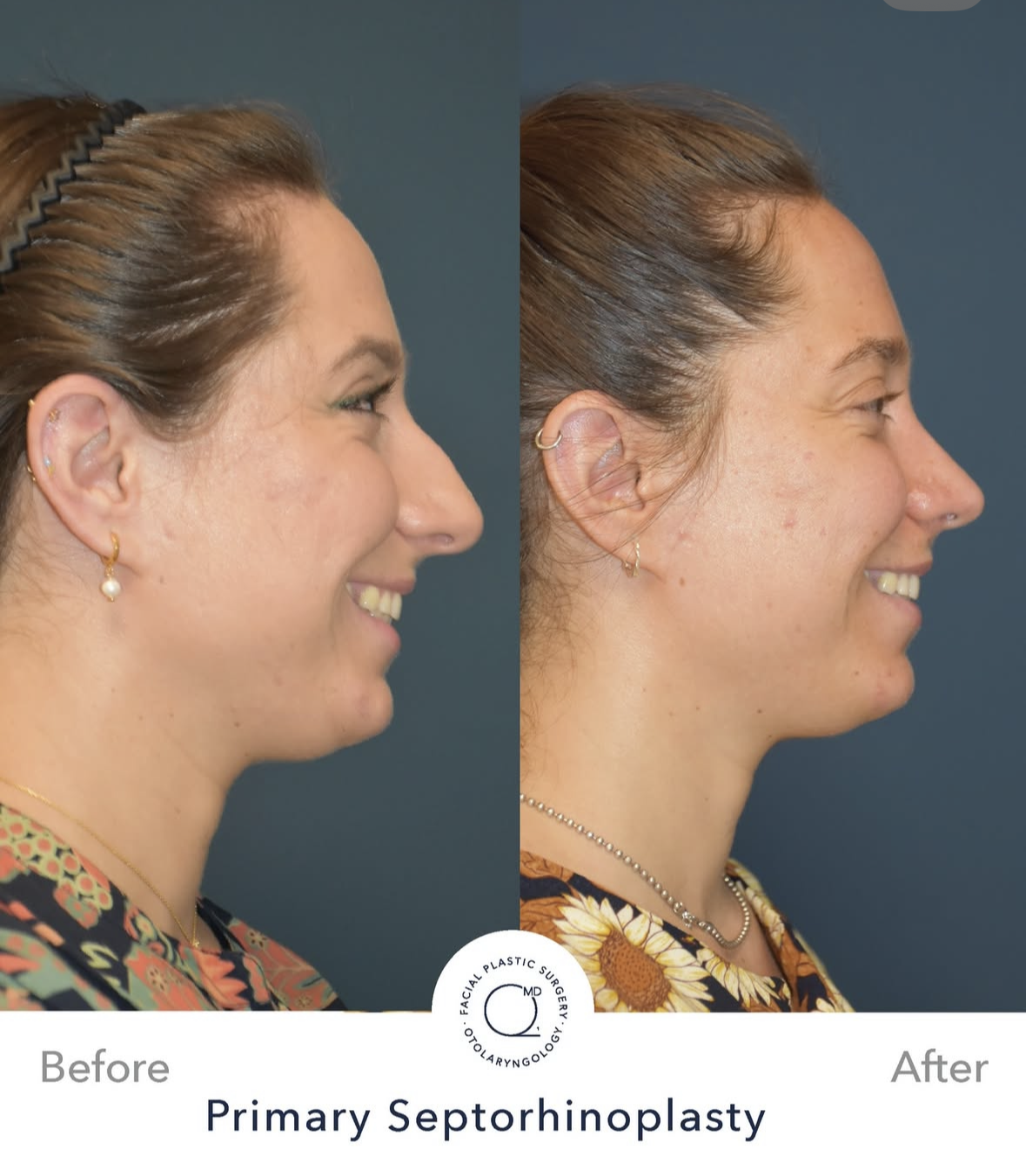 Rinoplastia femenina antes y después — fotografía 6