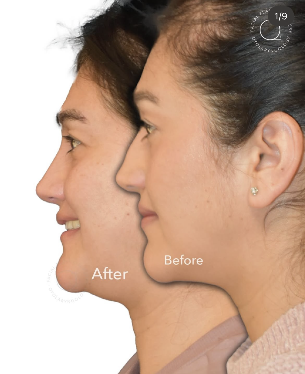 Rinoplastia femenina antes y después
