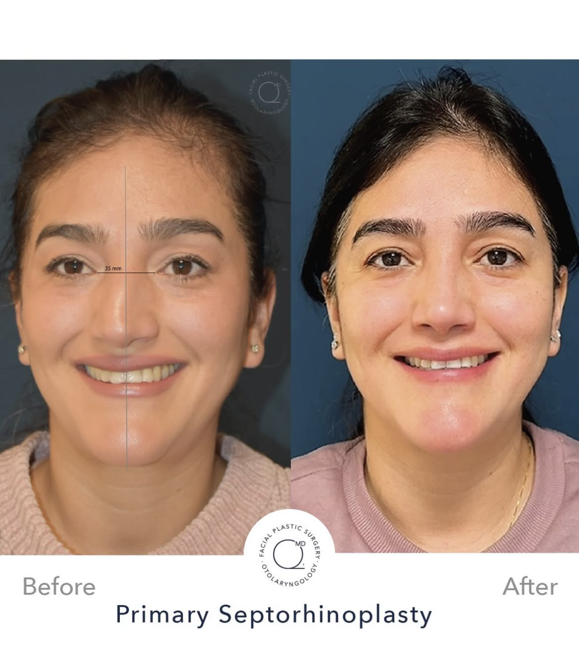 Rinoplastia femenina antes y después — fotografía 1