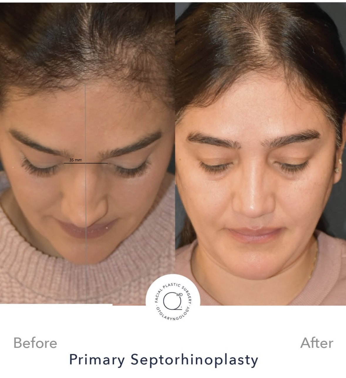 Rinoplastia femenina antes y después — fotografía 2