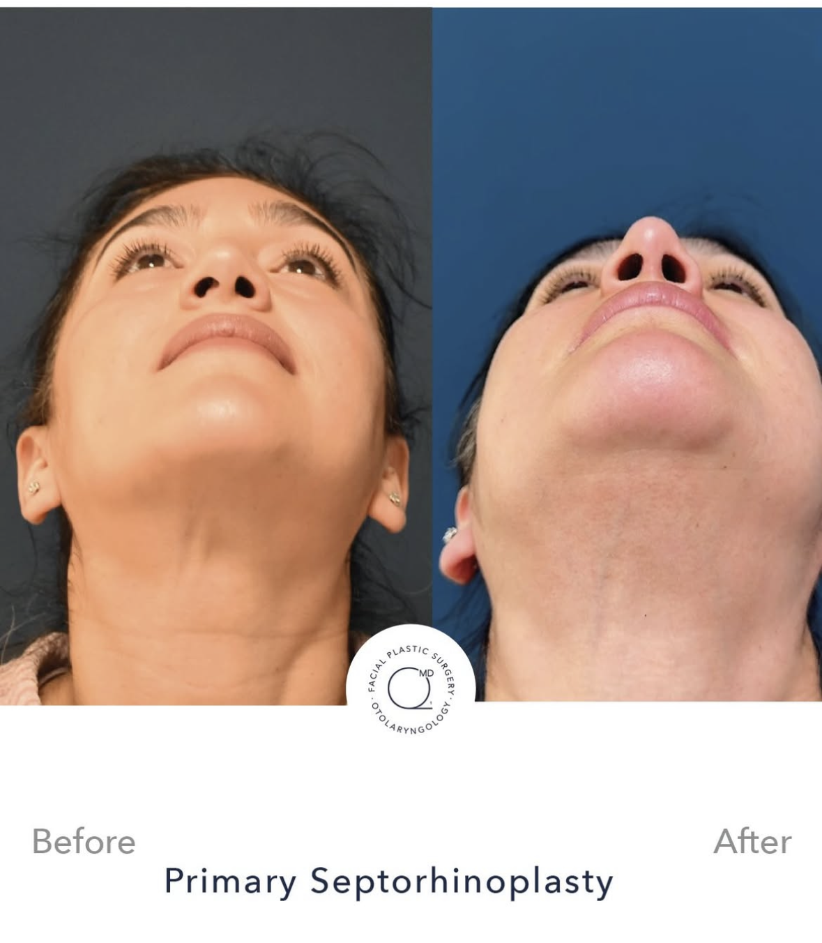 Rinoplastia femenina antes y después — fotografía 3