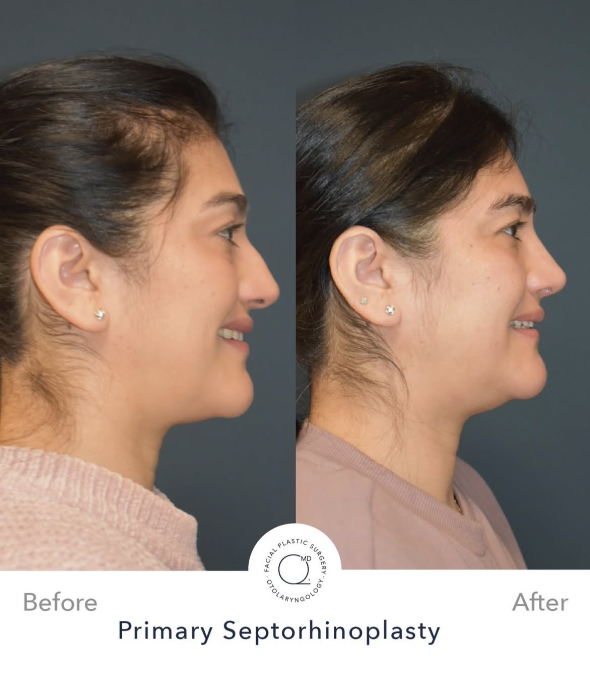 Rinoplastia femenina antes y después — fotografía 4