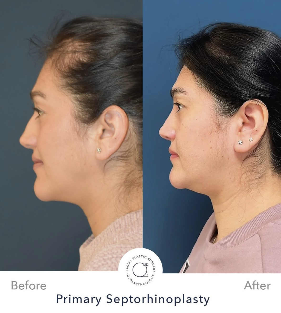 Rinoplastia femenina antes y después — fotografía 5