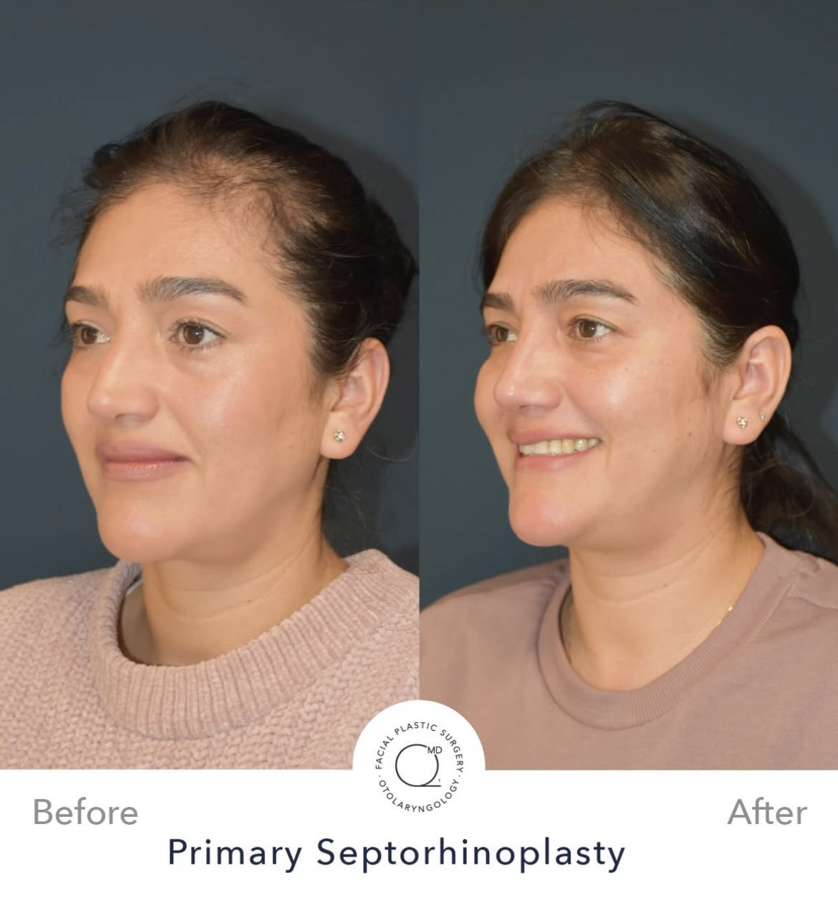 Rinoplastia femenina antes y después — fotografía 6