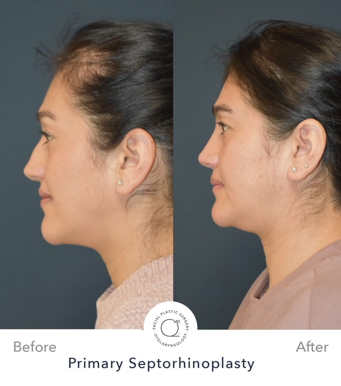 Rinoplastia femenina antes y después — fotografía 7
