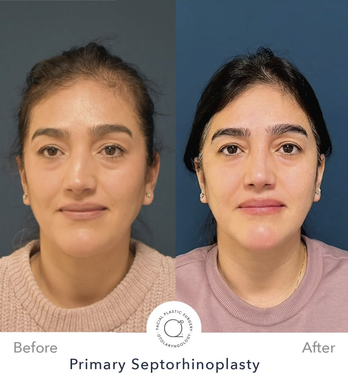 Rinoplastia femenina antes y después — fotografía 8