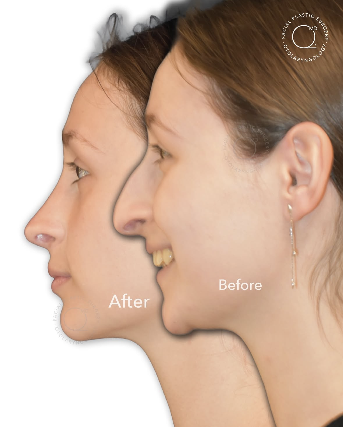 Rinoplastia femenina antes y después