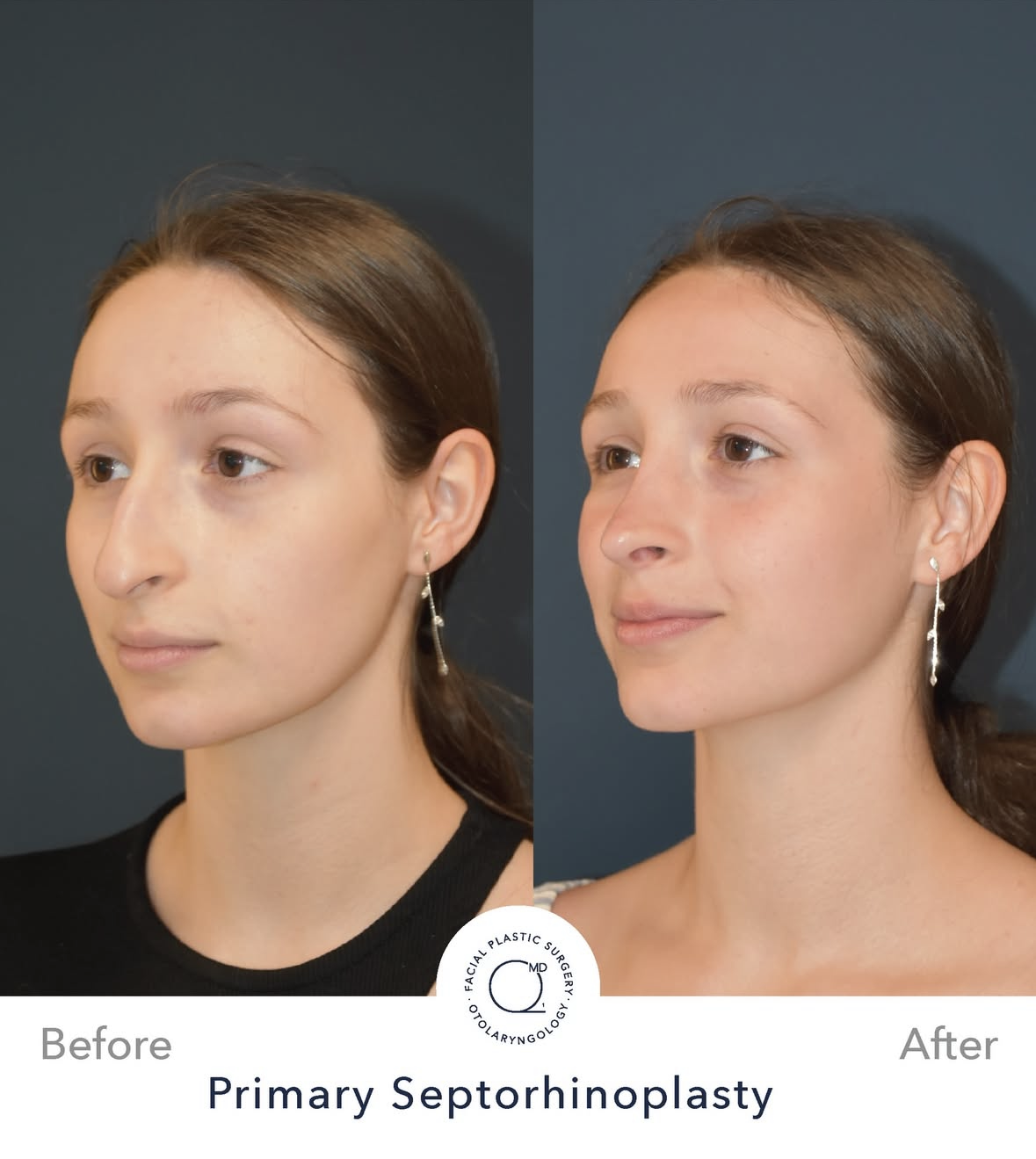 Rinoplastia femenina antes y después — fotografía 1