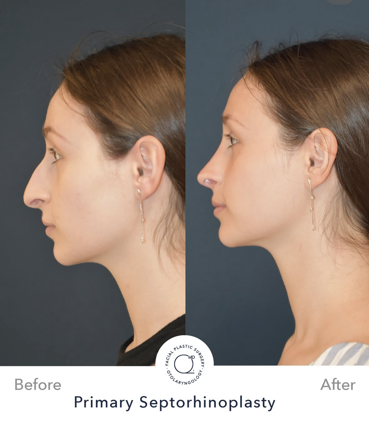 Rinoplastia femenina antes y después — fotografía 2