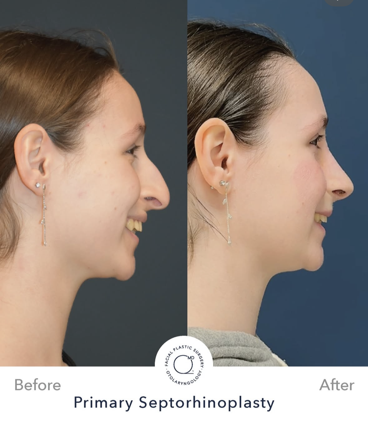 Rinoplastia femenina antes y después — fotografía 3