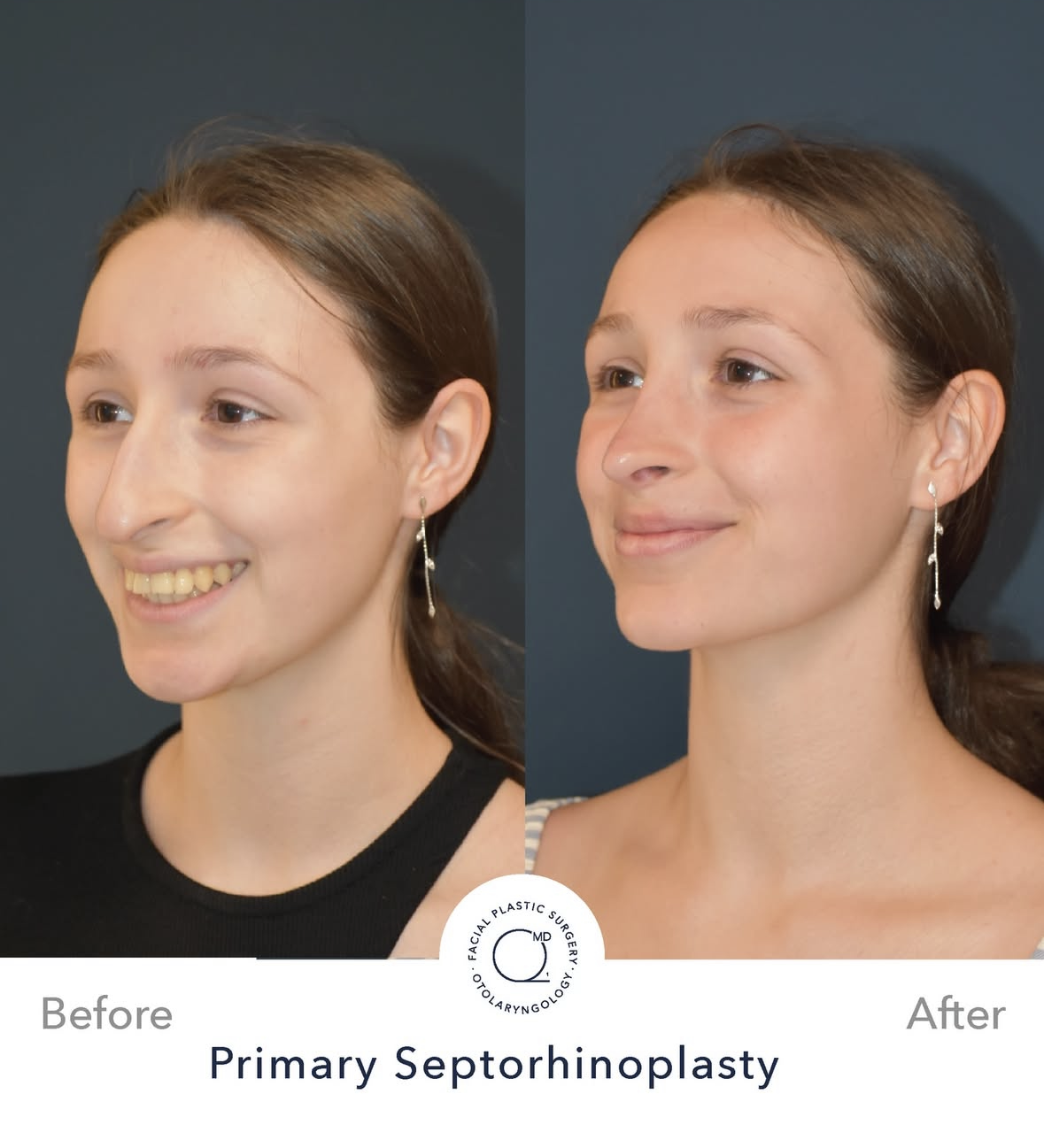 Rinoplastia femenina antes y después — fotografía 4