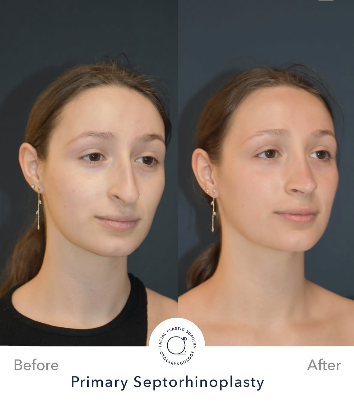 Rinoplastia femenina antes y después — fotografía 5