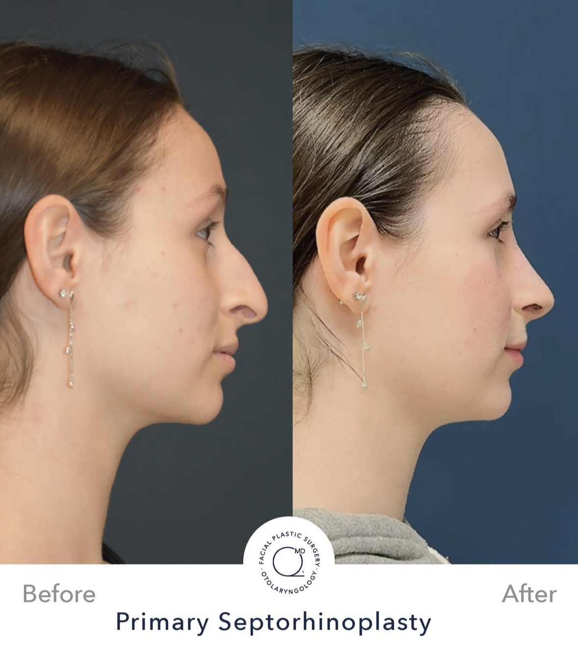 Rinoplastia femenina antes y después — fotografía 6