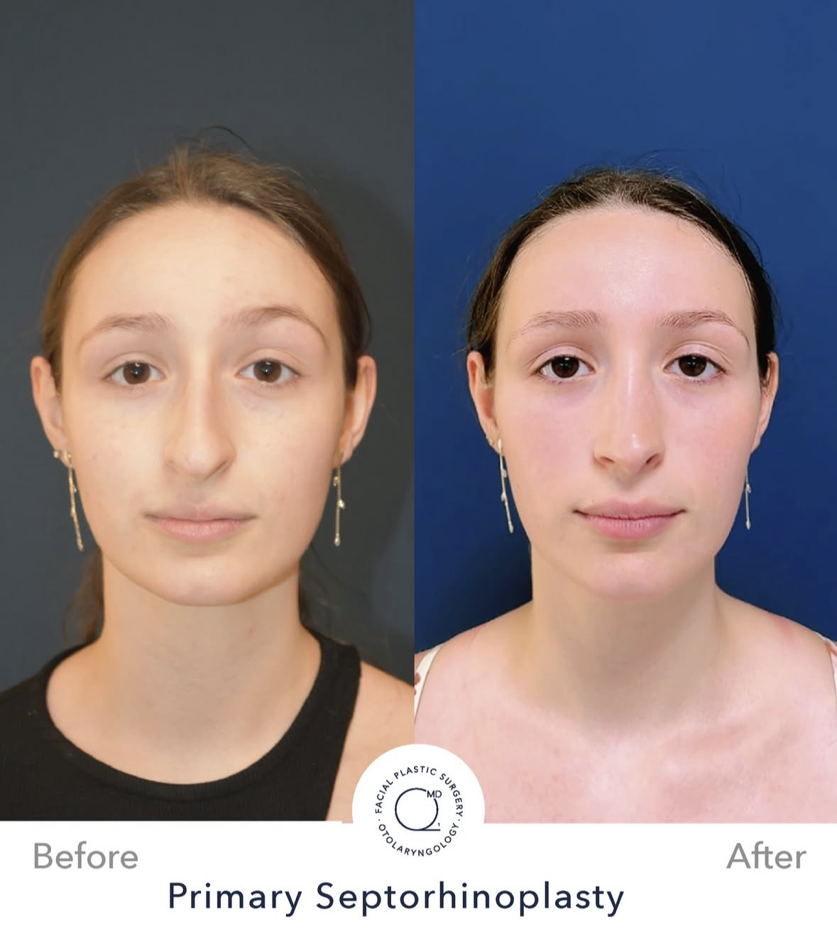 Rinoplastia femenina antes y después — fotografía 7