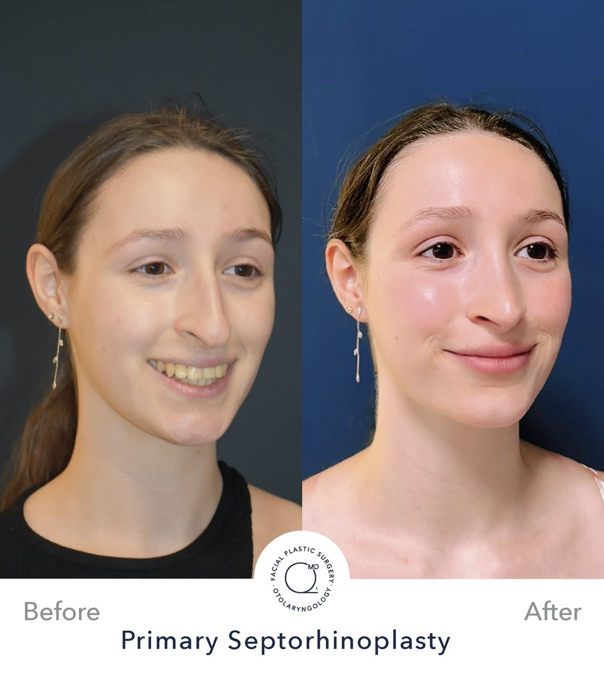 Rinoplastia femenina antes y después — fotografía 8