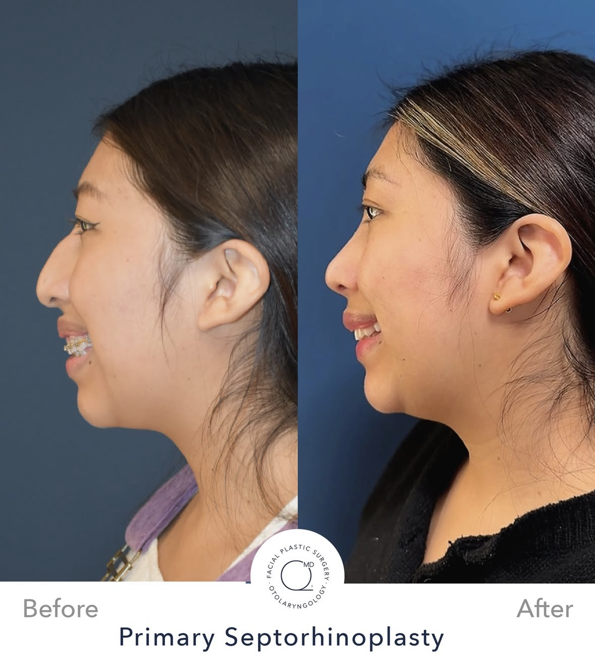 Rinoplastia femenina antes y después — fotografía 1