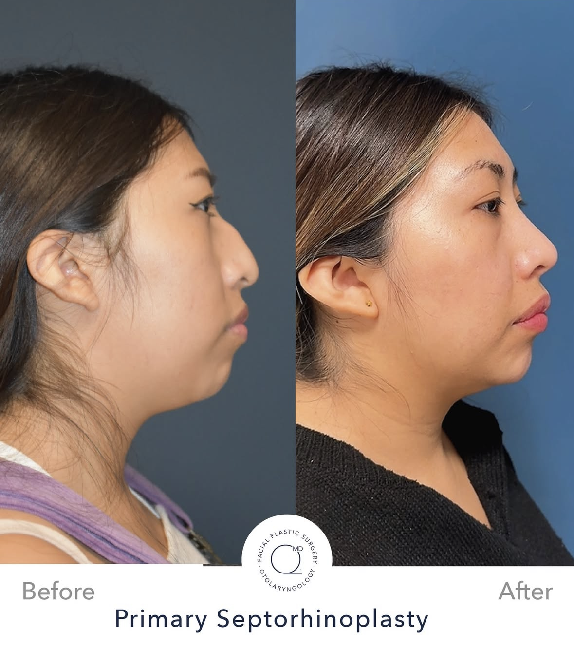 Rinoplastia femenina antes y después — fotografía 2