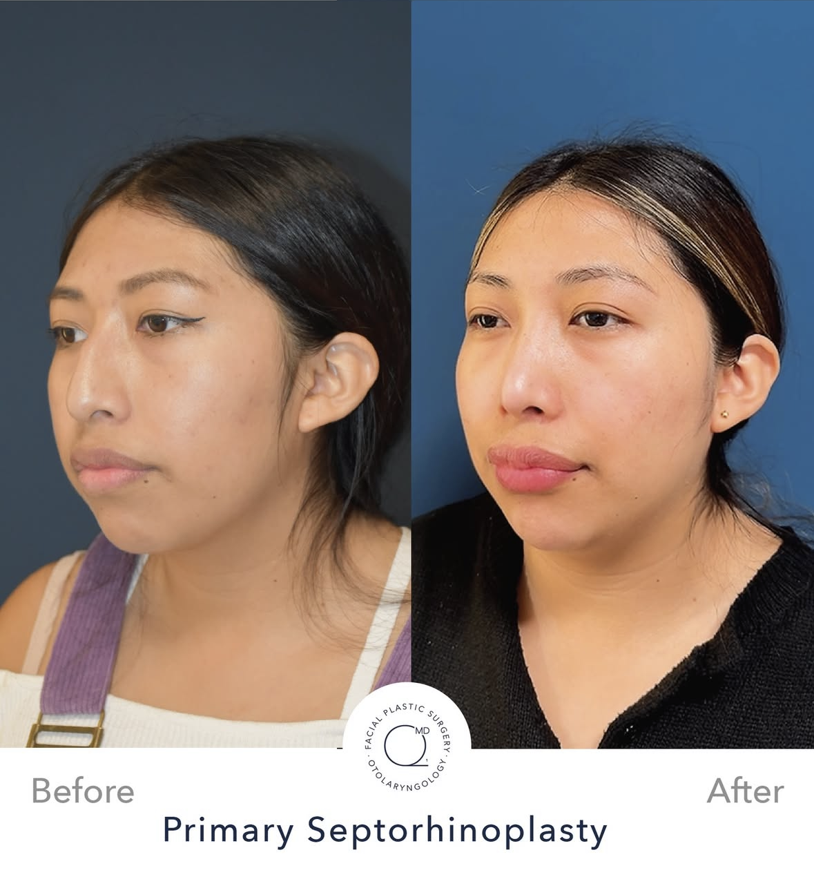 Rinoplastia femenina antes y después — fotografía 3