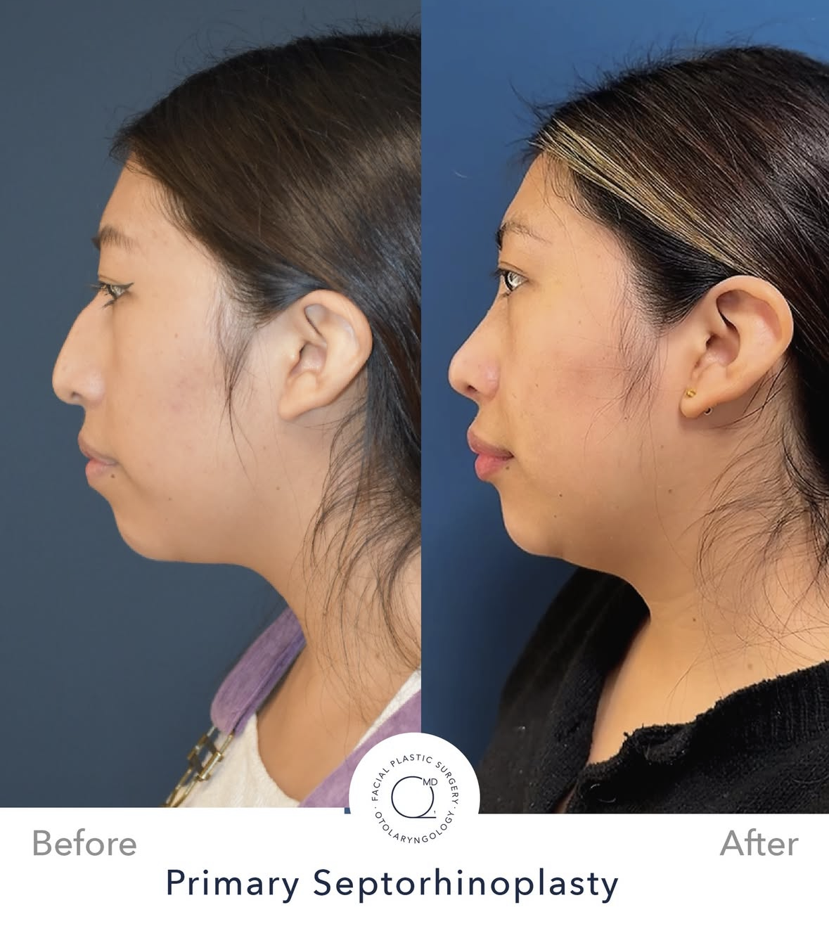 Rinoplastia femenina antes y después — fotografía 4