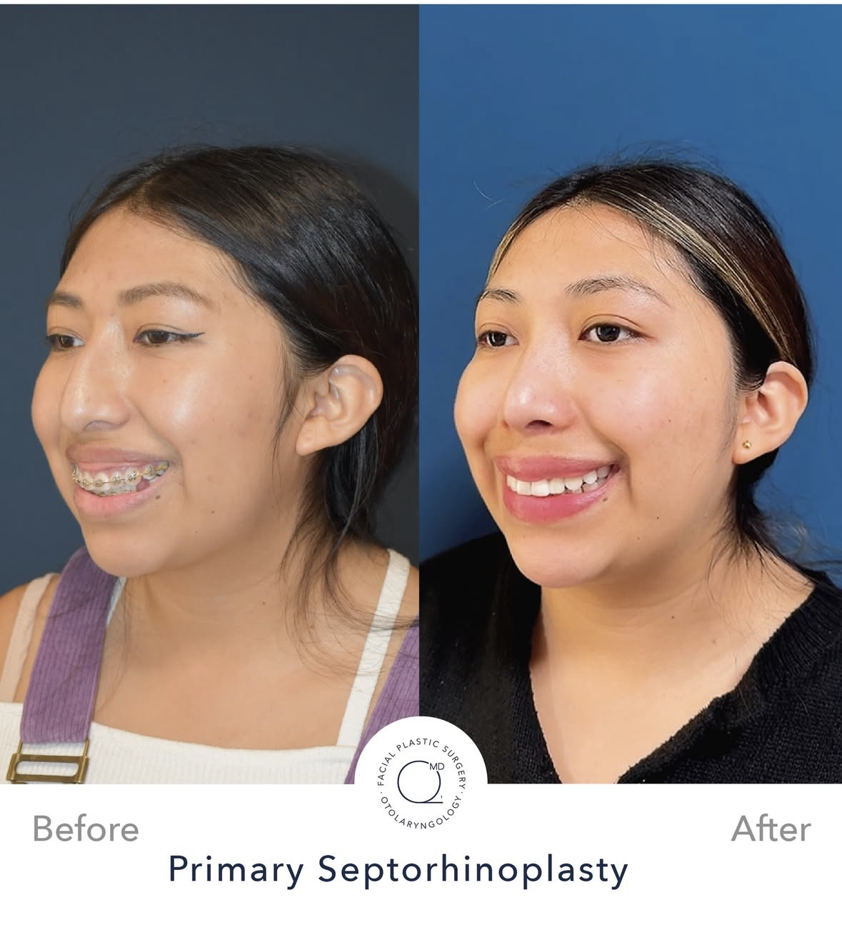 Rinoplastia femenina antes y después — fotografía 5