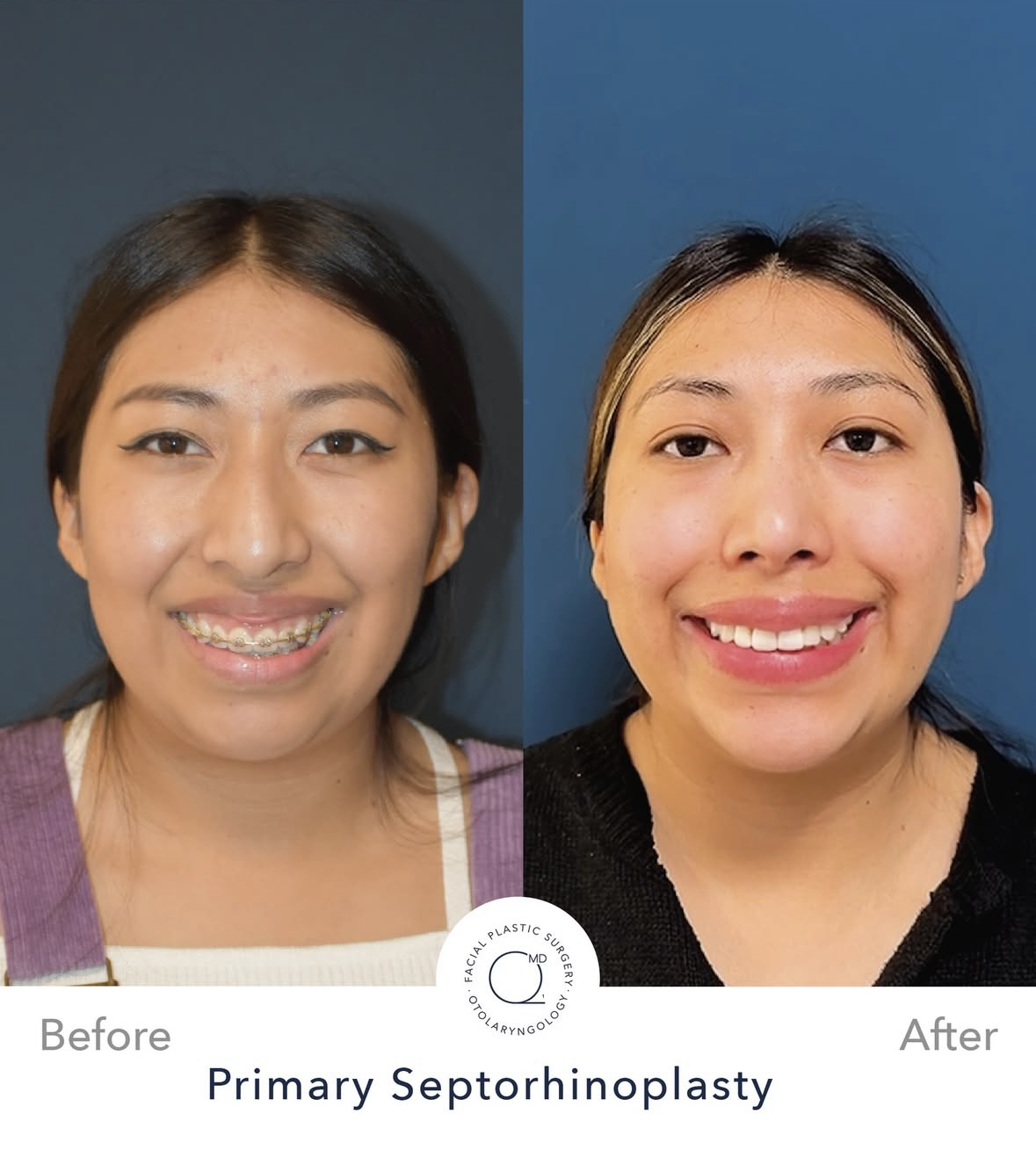 Rinoplastia femenina antes y después — fotografía 6