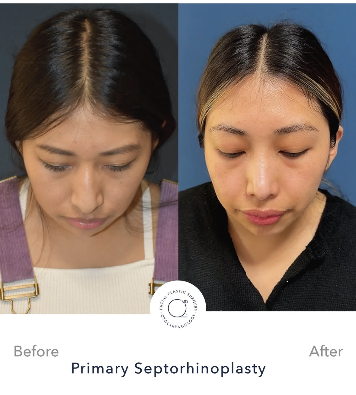 Rinoplastia femenina antes y después — fotografía 7