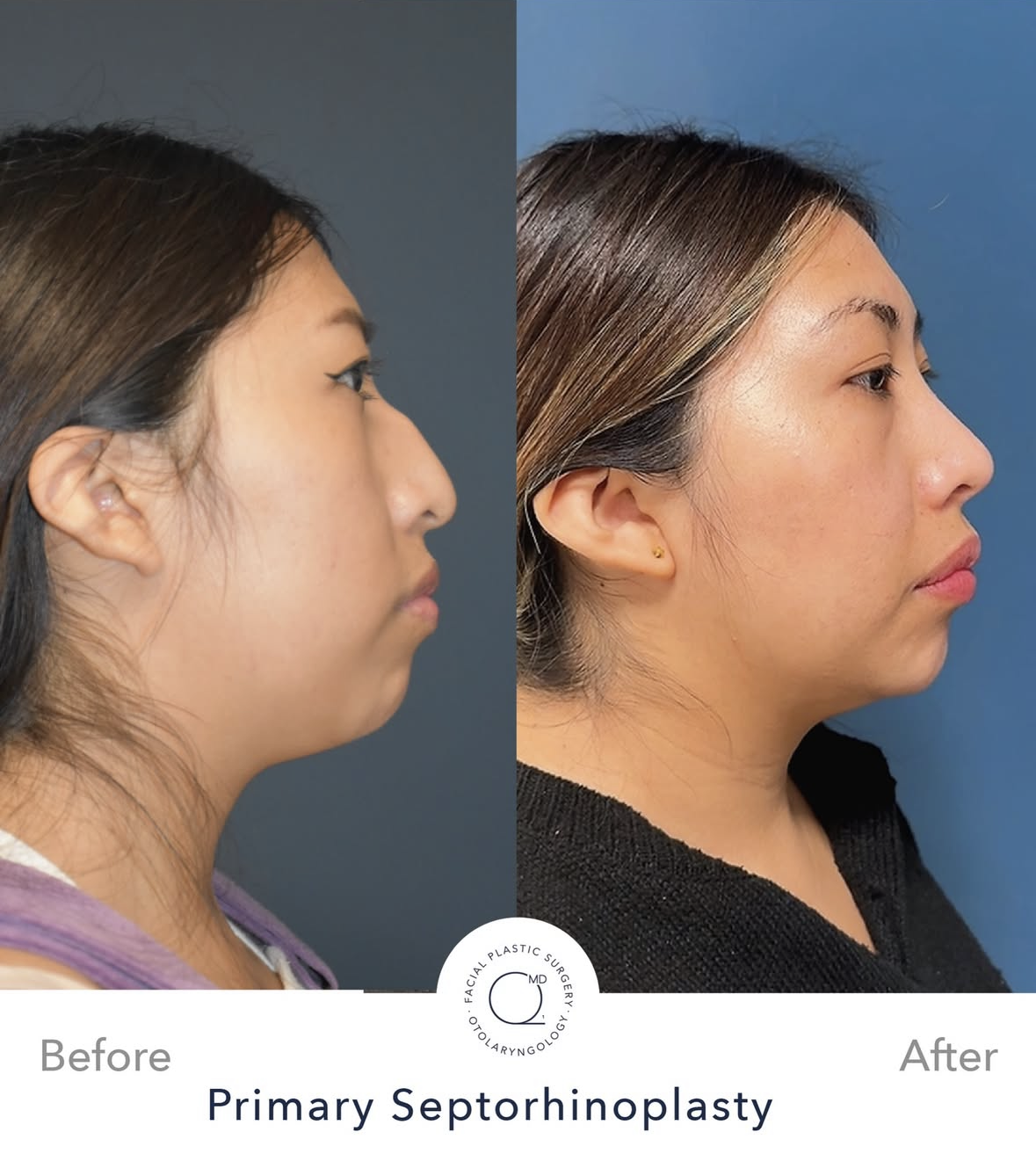 Rinoplastia femenina antes y después — fotografía 8