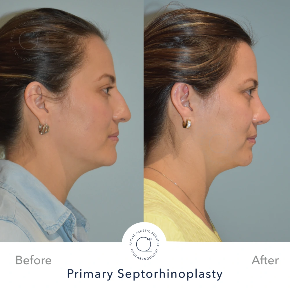 Caso 8 · septorrinoplastia primaria funcional por abordaje cerrado · resultado documentado a 24 meses Caso 8 · septorrinoplastia primaria funcional por abordaje cerrado · resultado documentado a 24 meses · fotografía 2