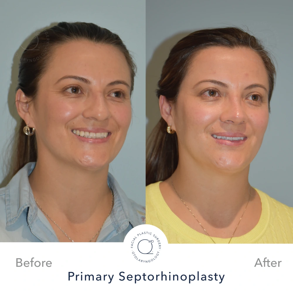 Caso 8 · septorrinoplastia primaria funcional por abordaje cerrado · resultado documentado a 24 meses Caso 8 · septorrinoplastia primaria funcional por abordaje cerrado · resultado documentado a 24 meses · fotografía 3