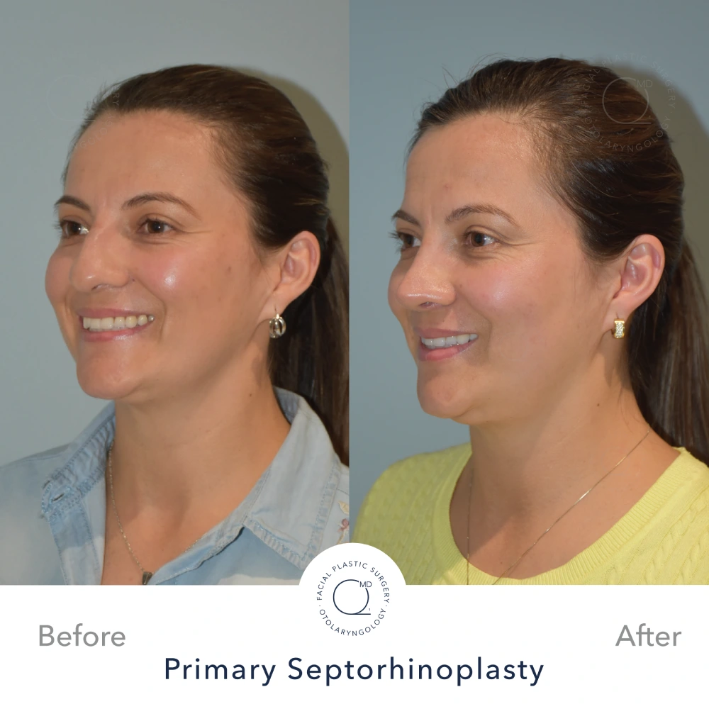 Caso 8 · septorrinoplastia primaria funcional por abordaje cerrado · resultado documentado a 24 meses Caso 8 · septorrinoplastia primaria funcional por abordaje cerrado · resultado documentado a 24 meses · fotografía 4