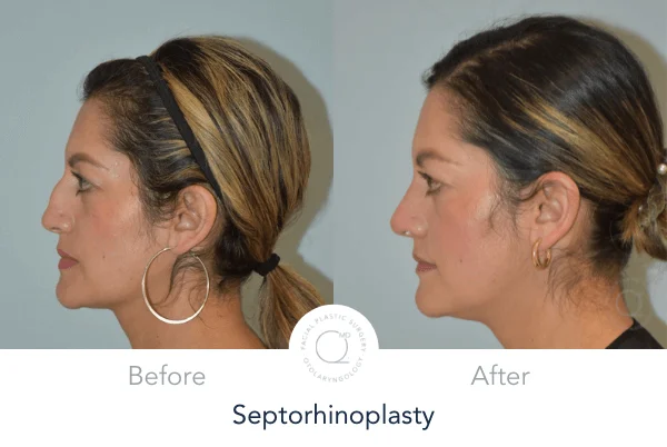 Rinoplastia Madrid caso 1 fotografía 1